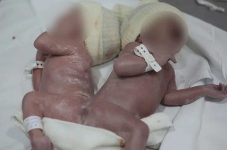 Gêmeos nascem unidos por osso da coluna no Paraná; caso é considerado raro, diz médica
